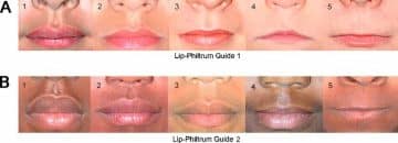 What You Should Know About Philtrum (With Pictures, Videos, And Faqs) Variations Of The Philtrum - Healthsoothe