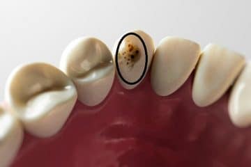 Identifying Cavities: What Does Dental Decay Look Like? What Tooth Cavity Looks Like