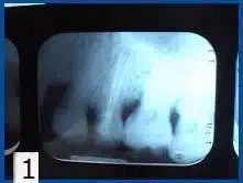 Identifying Cavities: What Does Dental Decay Look Like? What Tooth Cavity Looks Like On X-Ray