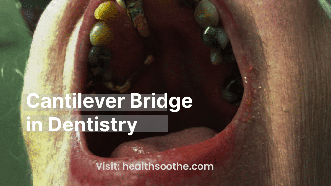 Cantilever Bridge In Dentistry: A Comprehensive Guide Cantilever Bridge In Dentistry