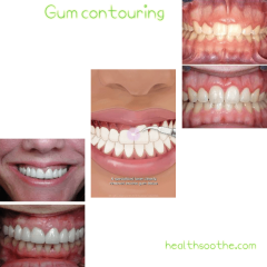 Gum Contouring: Best Candidates, Treatments, And Insurance Gum Contouring