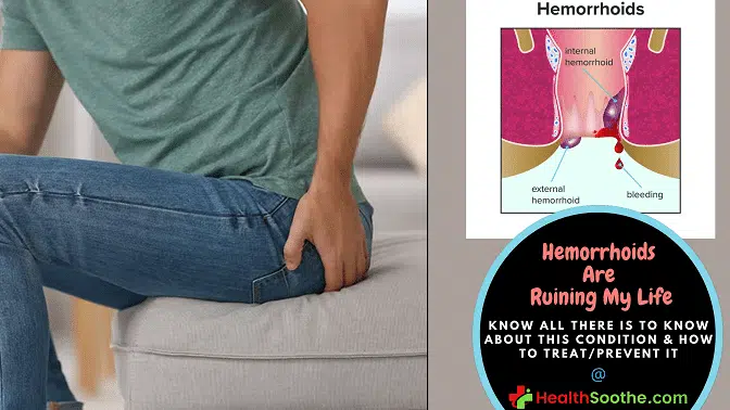 Hemorrhoids Are Ruining My Life! | What Do I Do?! Hemorrhoids Are Ruining My Life - Healthsoothe