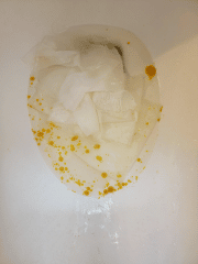 Keriorrhea | Symptoms, Causes, Treatments, And Prevention Keriorrhea - Healthsoothe