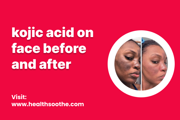 Kojic Acid On Face Before And After Kojic Acid On Face Before And After