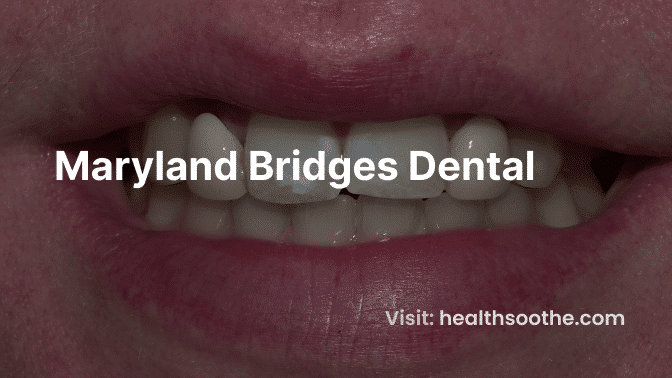 Enhancing Chewing Ability: The Role Of Dental Bridges Maryland Bridges Dental