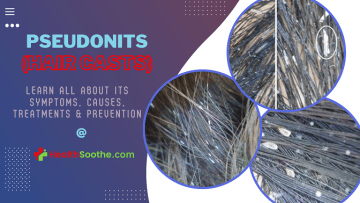 La Fonte Des Cheveux : Causes Et Tout Ce Que Vous Devez Savoir Pseudonits - Healthsoothe