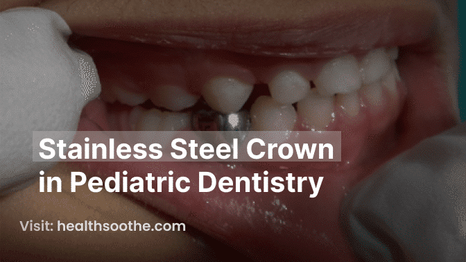 Stainless Steel Crown In Pediatric Dentistry: A Strong And Reliable Solution For Children'S Teeth Stainless Steel Crown In Pediatric Dentistry