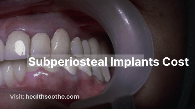 Exploring Subperiosteal Implants Cost: Understanding The Financial Aspects Subperiosteal Implants Cost