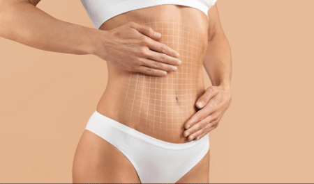 Your Guide To A Tummy Tuck: Before, During, And After Your Guide To A Tummy Tuck: Before, During, And After