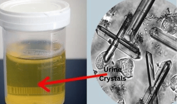 Crystals In Urine | Find Out What Causes This, The Symptoms, Treatments, And Prevention Crystals In Urine - Healthsoothe